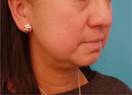 Before Image: Jowl/Jawline Contouring Kybella Patient #8 - 