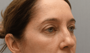 Blepharoplasty Before and After NYC