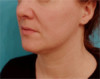 Jowl/Jawline Contouring Kybella Patient #9 Before Photo Thumbnail # 7