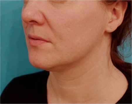 Jowl/Jawline Contouring Kybella Patient #9 Before Photo # 7