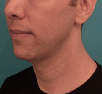 Jowl/Jawline Contouring Kybella Patient #11 Before Photo # 9