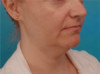 Jowl/Jawline Contouring Kybella Patient #10 Before Photo Thumbnail # 3