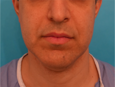 Jowl/Jawline Contouring Kybella Patient #7 Before Photo Thumbnail # 1