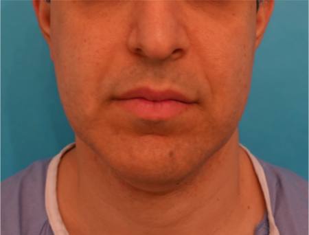 Kybella (Body Contouring) Patient