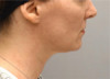 Jowl/Jawline Contouring Kybella Patient #9 After Photo Thumbnail # 6