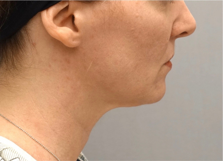 Jowl/Jawline Contouring Kybella Patient #9 After Photo # 6