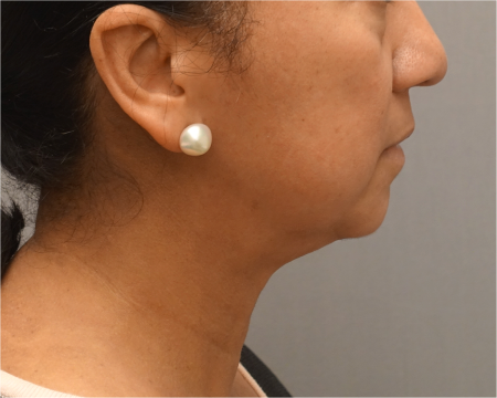 Jowl/Jawline Contouring Kybella Patient #8 After Photo # 6