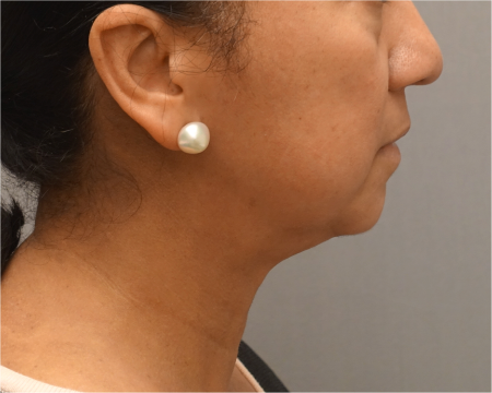 After Image: Jowl/Jawline Contouring Kybella Patient #8 - 
