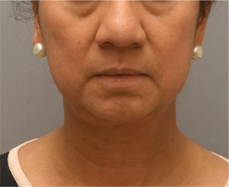 Jowl/Jawline Contouring Kybella Patient #8 After Photo Thumbnail # 2