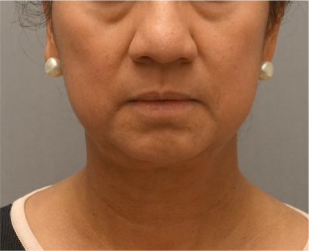 After Image: Jowl/Jawline Contouring Kybella Patient #8 - 