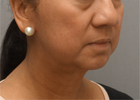 Jowl/Jawline Contouring Kybella Patient #8 After Photo # 4