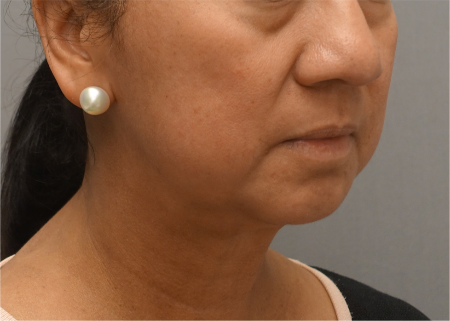 After Image: Jowl/Jawline Contouring Kybella Patient #8 - 