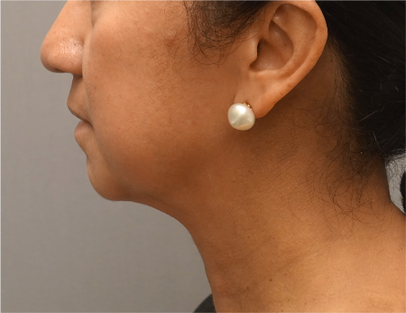 After Image: Jowl/Jawline Contouring Kybella Patient #8 - 