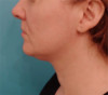 Jowl/Jawline Contouring Kybella Patient #9 Before Photo Thumbnail # 9