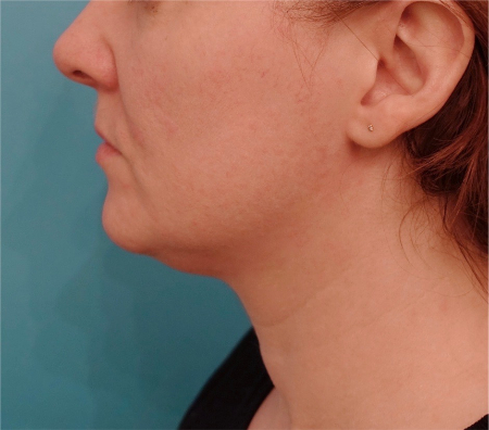 Jowl/Jawline Contouring Kybella Patient #9 Before Photo # 9