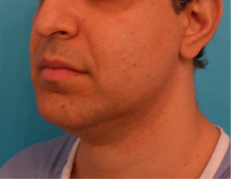 Jowl/Jawline Contouring Kybella Patient #7 Before Photo # 7