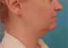 Jowl/Jawline Contouring Kybella Patient #10 Before Photo Thumbnail # 5