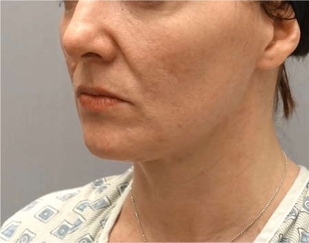 Jowl/Jawline Contouring Kybella Patient #9 After Photo # 8