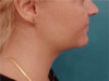 Jowl/Jawline Contouring Kybella Patient #10 After Photo Thumbnail # 6