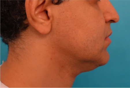 Jowl/Jawline Contouring Kybella Patient #7 Before Photo # 5