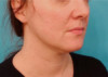 Jowl/Jawline Contouring Kybella Patient #9 Before Photo Thumbnail # 3