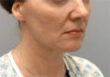 Jowl/Jawline Contouring Kybella Patient #9 After Photo Thumbnail # 4