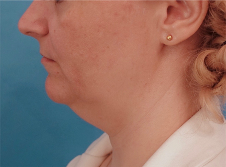 Jowl/Jawline Contouring Kybella Patient #10 Before Photo # 9