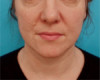 Jowl/Jawline Contouring Kybella Patient #9 Before Photo Thumbnail # 1