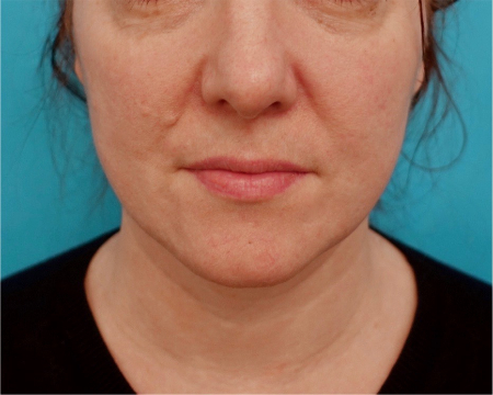Jowl/Jawline Contouring Kybella Patient #9 Before Photo # 1