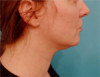 Jowl/Jawline Contouring Kybella Patient #9 Before Photo Thumbnail # 5