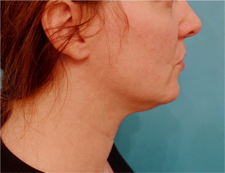 Jowl/Jawline Contouring Kybella Patient #9 Before Photo # 5