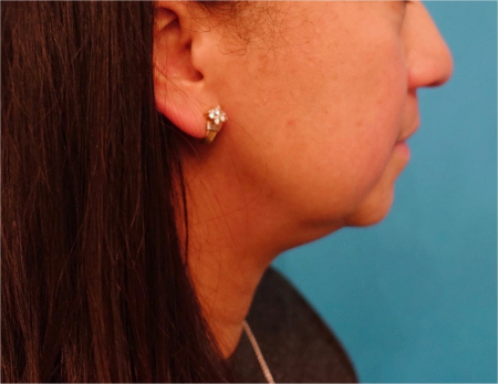 Before Image: Jowl/Jawline Contouring Kybella Patient #8 - 
