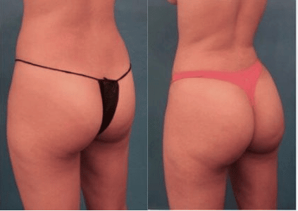 woman’s rear end in underwear before and after Brazilian butt lift, buttocks rounder after procedure