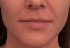 Juvederm Ultra Plus Before