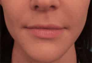 Juvederm Ultra Plus After