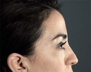 NYC Rhinoplasty Before and After NYC Rhinoplasty Before and After