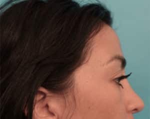NYC Rhinoplasty Before and After