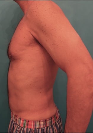 Male Liposuction Patient NYC