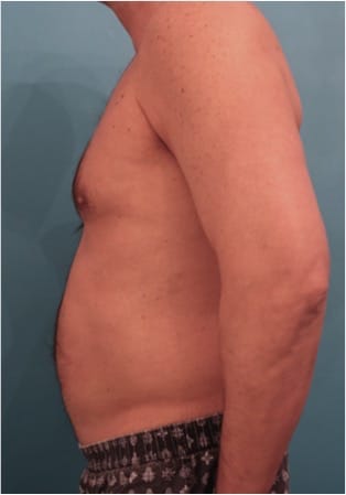 Male Liposuction Patient NYC