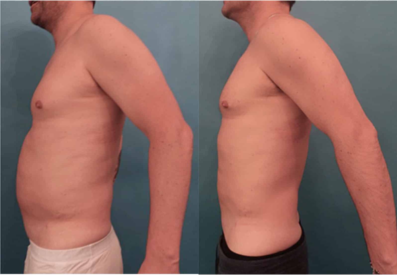 A before and after image set of a man that underwent a Kybella body contouring in NYC