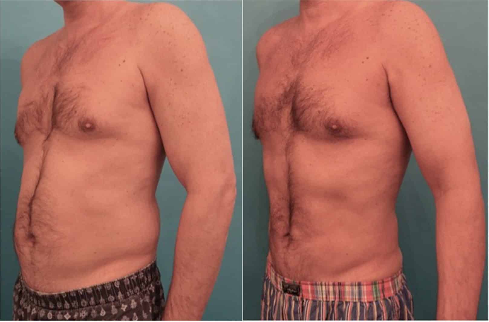 A before and after image set of a man that underwent a Liposuction in NYC