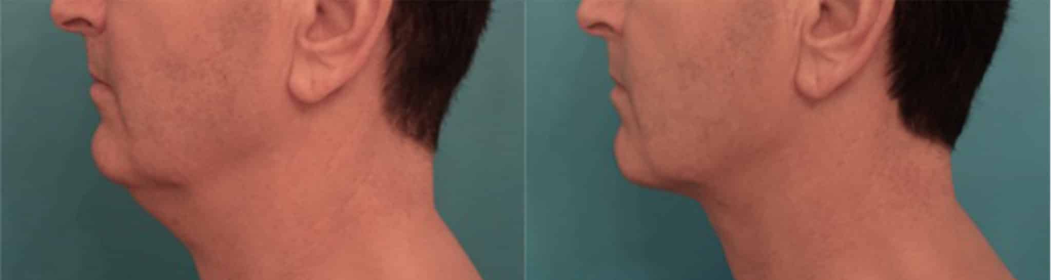 man before and after kybella injections, more pronounced chin and less neck fat after procedure