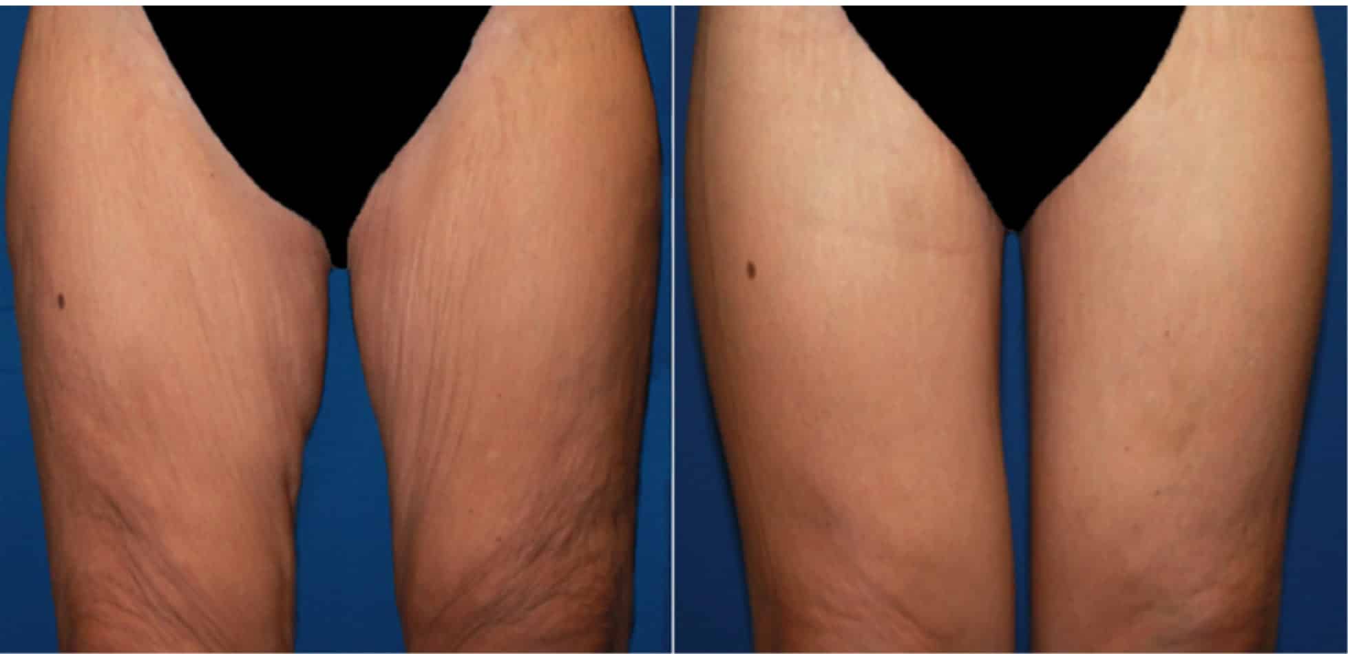 A before and after image set of a woman that underwent a Thigh Lift in NYC