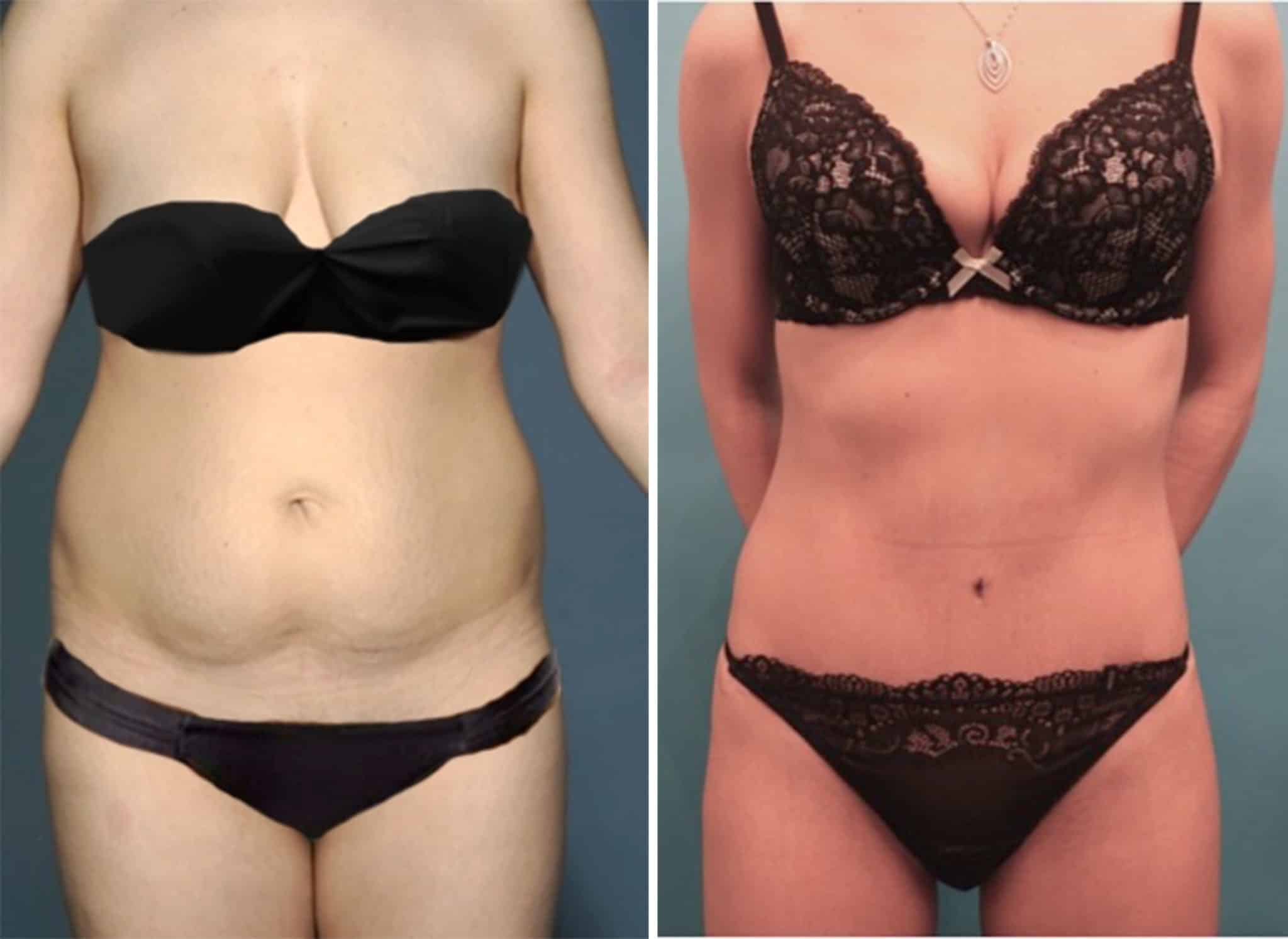 woman in black underwear before and after tummy tuck, much flatter stomach after procedure