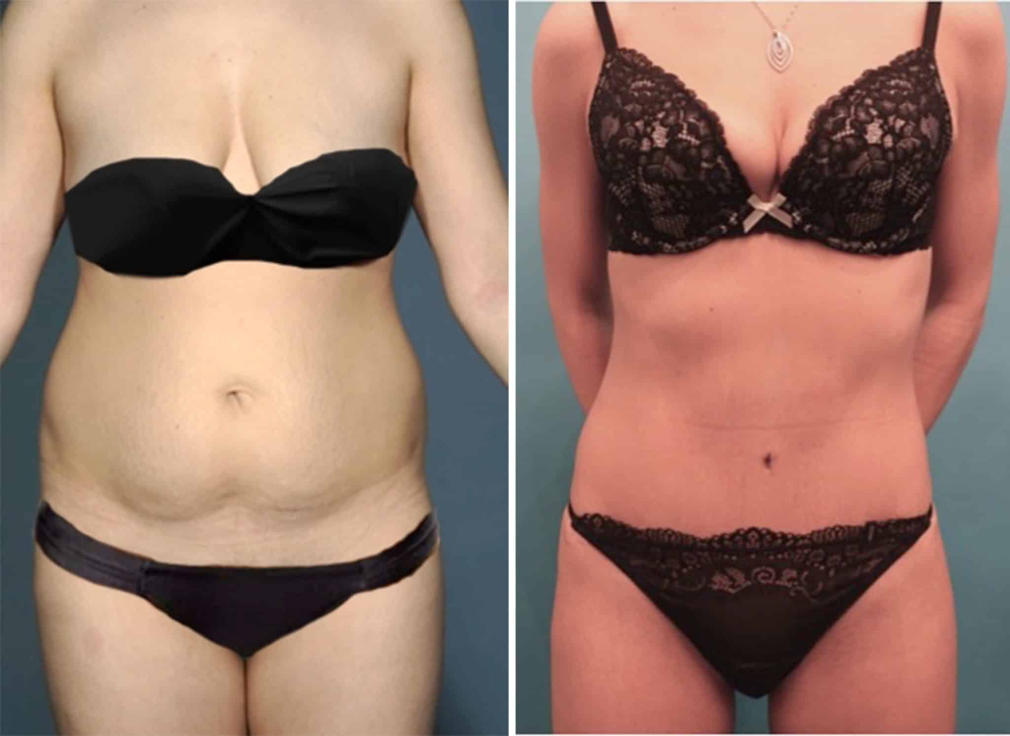 Tummy Tuck in NYC, Abdominoplasty