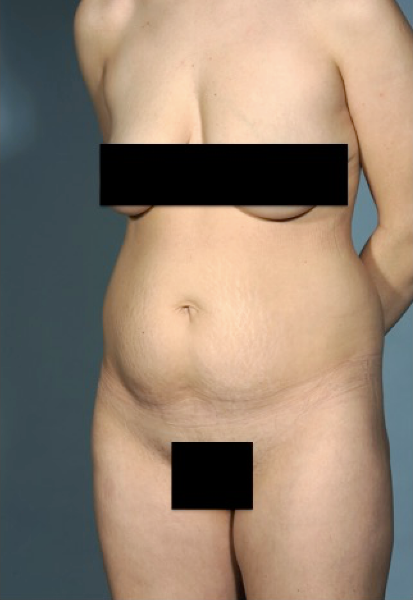 Abdominoplasty/ Tummy Tuck Patient #1 Before Photo Thumbnail # 5