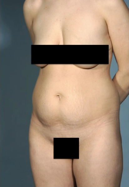 Abdominoplasty/ Tummy Tuck Patient #1 Before Photo # 5