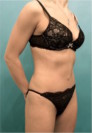 Abdominoplasty/ Tummy Tuck Patient #1 After Photo Thumbnail # 4
