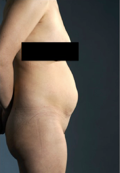 Abdominoplasty/ Tummy Tuck Patient #1 Before Photo # 9