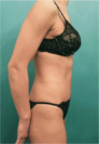 Abdominoplasty/ Tummy Tuck Patient #1 After Photo Thumbnail # 10
